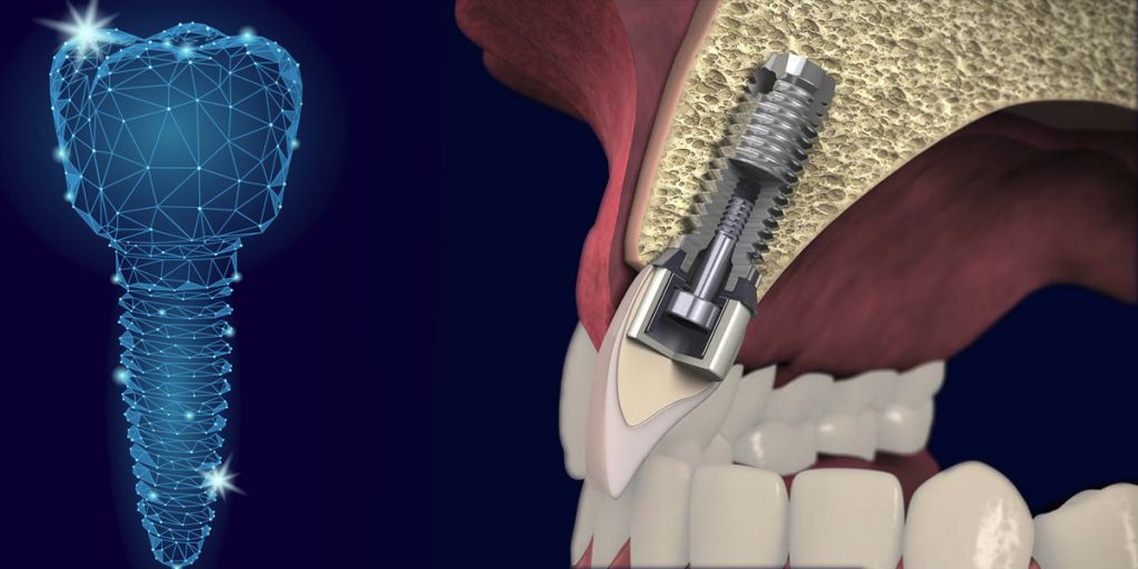 Mitos implantes dentales