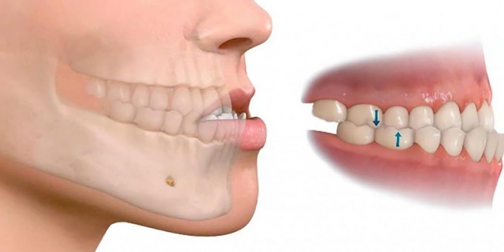 maloclusion dental tipo 2