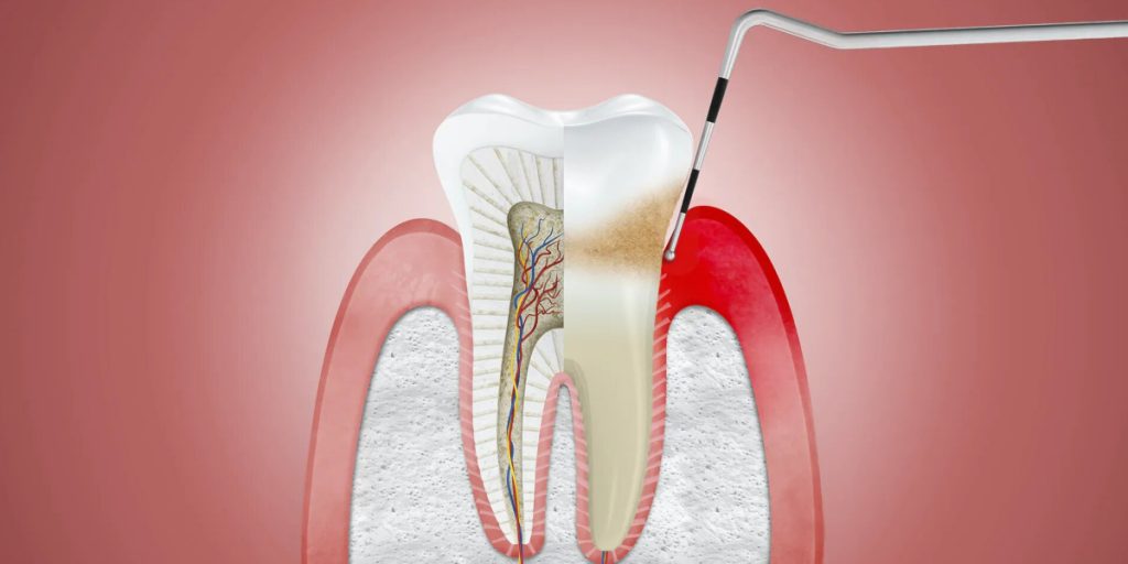 Gingivitis