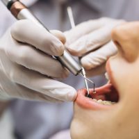Abceso dental
