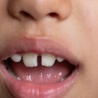 diastema
