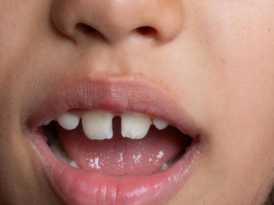 diastema