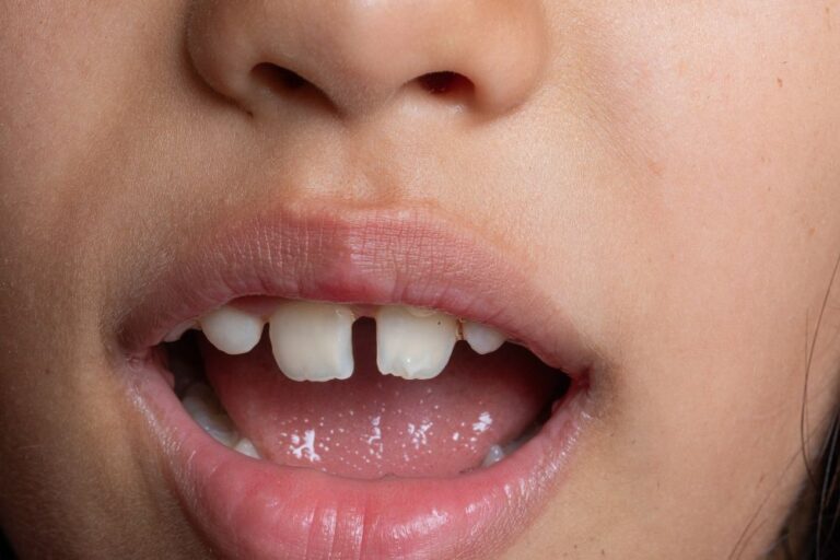 diastema